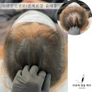 대전두피문신 내돈내산후기 실패와 성공의 갈림길!