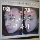 크라이오셀(Cryocell) | 프락셀 8회차 솔직 후기, 모공과 피부결 얼마나 달라졌을까?