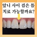 자이탑치과의원 | 걸포자이아파트치과, 레진치료 앞니 사이 검은 틈 치료 가능할까요?