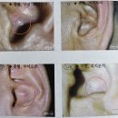 귀 건강학(이혈테라피) 이미지