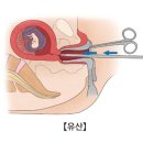 절박 유산[Threatened Abortion]여성질환 이미지