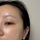청담짝태앤연어 | 청담피부과 무통 리투오 통증 효과 모공개선 후기