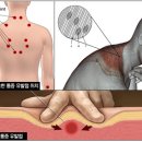 안아픈침한의원 네이버블로그