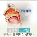 비인두암 증상과 원인 그리고 치료 이미지