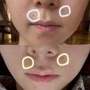 아름다운피부과의원 | 화명동피부과 아름다운의원, 입주변 뾰루지 여드름 레이저 3일차