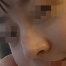 깎는여자 | 비개방 셀픽코수술 실제로 수술한 후기 (여자매부리코, 복코 탈출 성공ㅠ)