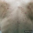 조태훈피부과의원 | 스테로이드여드름 - 대한임상피부관리학회 온라인저널 - 정종영