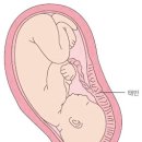 전치태반[placenta previa] 이미지