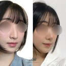 오블리성형외과의원 | 무보형물 코수술 후기와 효과 좋은 코 그리고 사용되는 재료는?