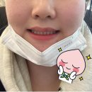 창원ㅇㄴㅅ의원에서 보톡스 맞고 한달차 후기 올려봐요!