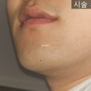 야탑 밴스의원 | 남자 하관 레이저 제모 무제한! 내돈내산 야탑 ‘밴스의원’ 솔직 후기