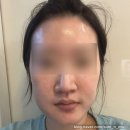 잠실새내 피부과모공관리 엑셀브이레이저후기
