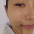 ○백석동열병합발전소 후문 | 수완지구 홍조피부관리 고민정피부연구소 대만족 효과후기