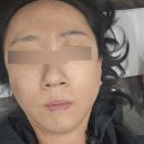 커피피코 - 53043 | 창원 피코프락셀 후기 효과·가격·시술 다운타임