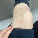 정강한의원 | 슬개건염 기록 (무릎 통증, 무릎 초음파, 무릎 주사, 물리치료, 후기)