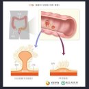 ﻿K63.5결장의 폴립과 결장의 선종성 폴립(D12.6)의 비교 이미지