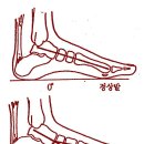 평발이 뭐고 왜 그렇게 되는거죠? 이미지