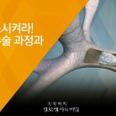 비수술적 폐용적 축소술 이미지