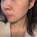 참제일의원 | 성수 프리미의원 리쥬란HB 내돈내산 솔직후기(엠보싱&amp;통증) 일주일 변화기록