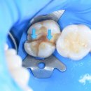 2080치과의원 | 치과> 어금니 씹을 때 통증, 크라운 대신 '레진 빌드업'으로 살린 1년 후기 - 에이엠치과 (대구 치과)