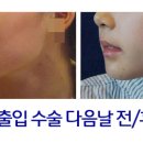 서울제일성형외과의원 네이버블로그