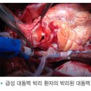 흉부대동맥류의 수술적 치료 및 혈관내 스텐트 삽입술 이미지