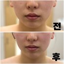 서천한의원 | 서천 하이퍼소닉관리 잘하는 &lt;반하다&gt; 후기