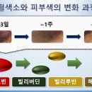 멍이 잘드는 이유 빠지는 시간 멍 빨리 빼는법 멍연고 노블루겔 벤트플라겔 이미지