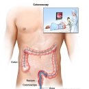 울산 박병원 내과, 대장용종, 대장내시경, 내시경 이미지