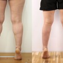 세이지의원 | [의료칼럼] 종아리알빼는방법으로 최적화된 쫑알주사 - 세이지의원 리포트