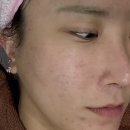 약초백화점 | 구월동 여드름 한의원 약초필링 후기 붓기 각질