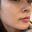 압구정 수약국 | 압구정 피부과 루비레이저 주의사항까지! 리얼 내돈내산후기