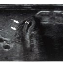 신생아의 무담석 담낭염 (Acalculous cholecystitis) 이미지