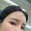 삼주메타 | 이마 필러 후기 엘란쎄 부작용 없던 효과 가격