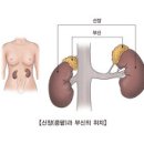 부신기능부전 (Adrenal Insufficiency) 이미지