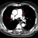 폐색전증pulmonary embolism 이미지