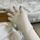 파더스화외과의원 | 분유포트 세척하다가 100도의 물에 화상입었지만, 흉터 없이 치료중. 하남 화상전문병원 파더스화외과의원