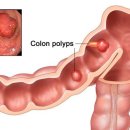 대장 용종과 대장암의 연관성에 대하여 이미지
