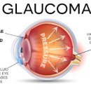 녹내장 초기 원인 30대 녹내장 이미지