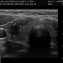 갑상선암 초음파사진 이미지