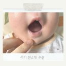 대곡소아과의원 | 신생아 설소대 수술, 애매하게 짧다는 소견일때? (시지 푸른연합소아과)