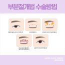부평메트로성형외과의원 | 메트로성형외과 "쌍꺼풀 수술 방법과 특징"