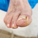 레푸스 방이역점 | 감일동 파고드는 발톱 고민? 레푸스 방이역점에서 시원하게 해결했어요!