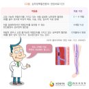 심부정맥혈전증 이미지