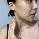 에이스 | 여의도 피부관리 에스테틱 l 에이스킨 여드름 압출 후기