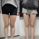 멍# | 대구 허벅지 지흡 6주차 지방흡입 후관리 방법 통증 멍 붓기 후기