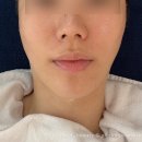볼륨톡스 | 이대피부관리 큐어에스테틱에서 에스테인 페이스핏톡스 볼륨 살린 후기