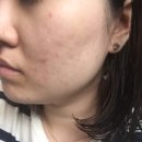 성인한의원 | 강남 성인여드름 한의원 피부 심부재생치료 과정과 후기