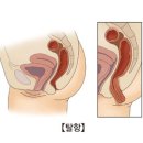 탈항[Anal prolapse]소화기질환 이미지