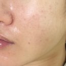 의정부 모공관리 , 라비엘뷰티 4회차 더마브레이젼 후기